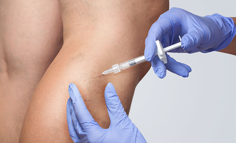 What Is Sclerotherapy?