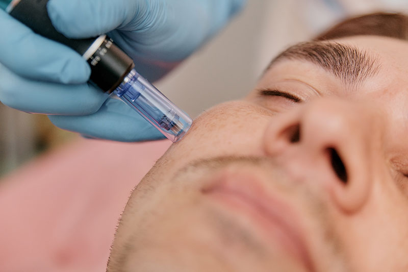 https://naples.thelaserloungespa.com/wp-content/uploads/2024/08/candidate-for-microneedling-estero-fl.jpg