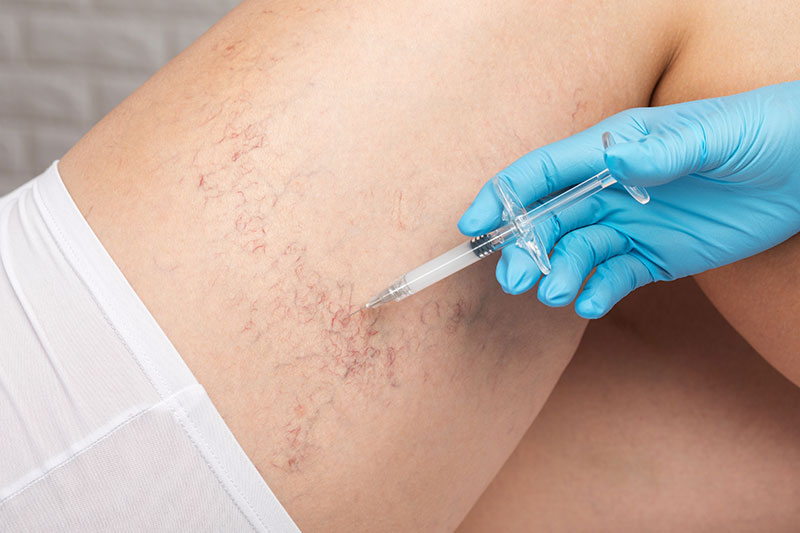 Am I a Candidate for Sclerotherapy?