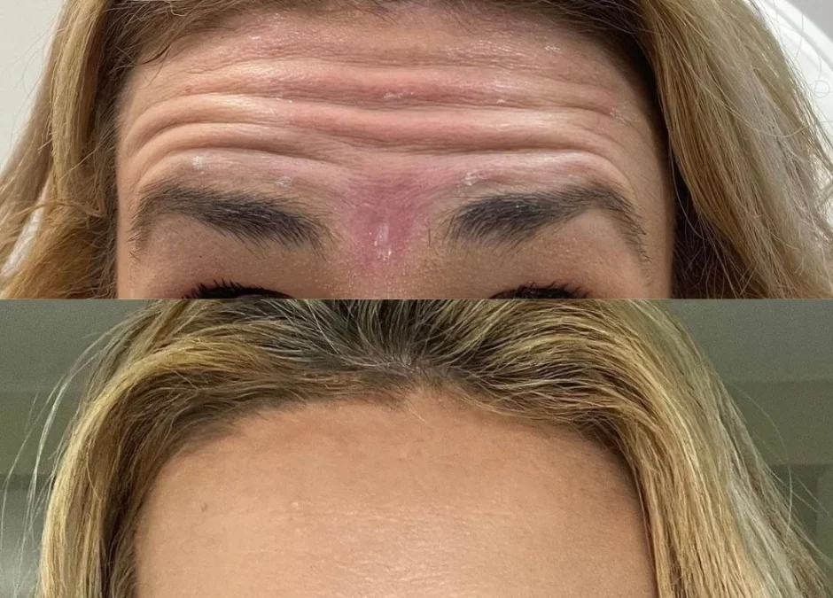 When to Start Using Xeomin: A Comprehensive Guide to Wrinkle Prevention